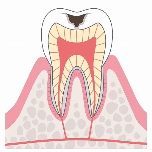 C2（象牙質の虫歯）