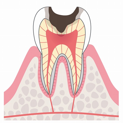 C3（神経の虫歯）