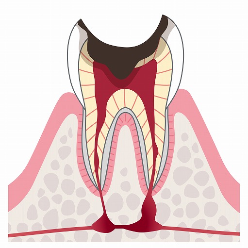 C4（歯根の虫歯）