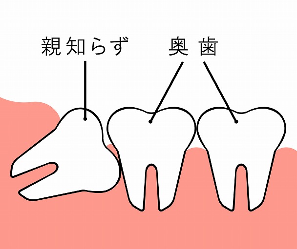 親知らずでお悩みではありませんか？